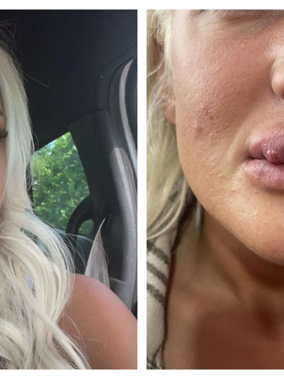 Split Nicole + faulende Lippe