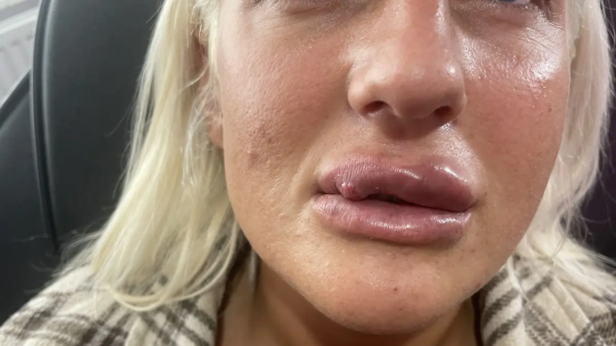 Nicole McManus’ faulende Lippe
