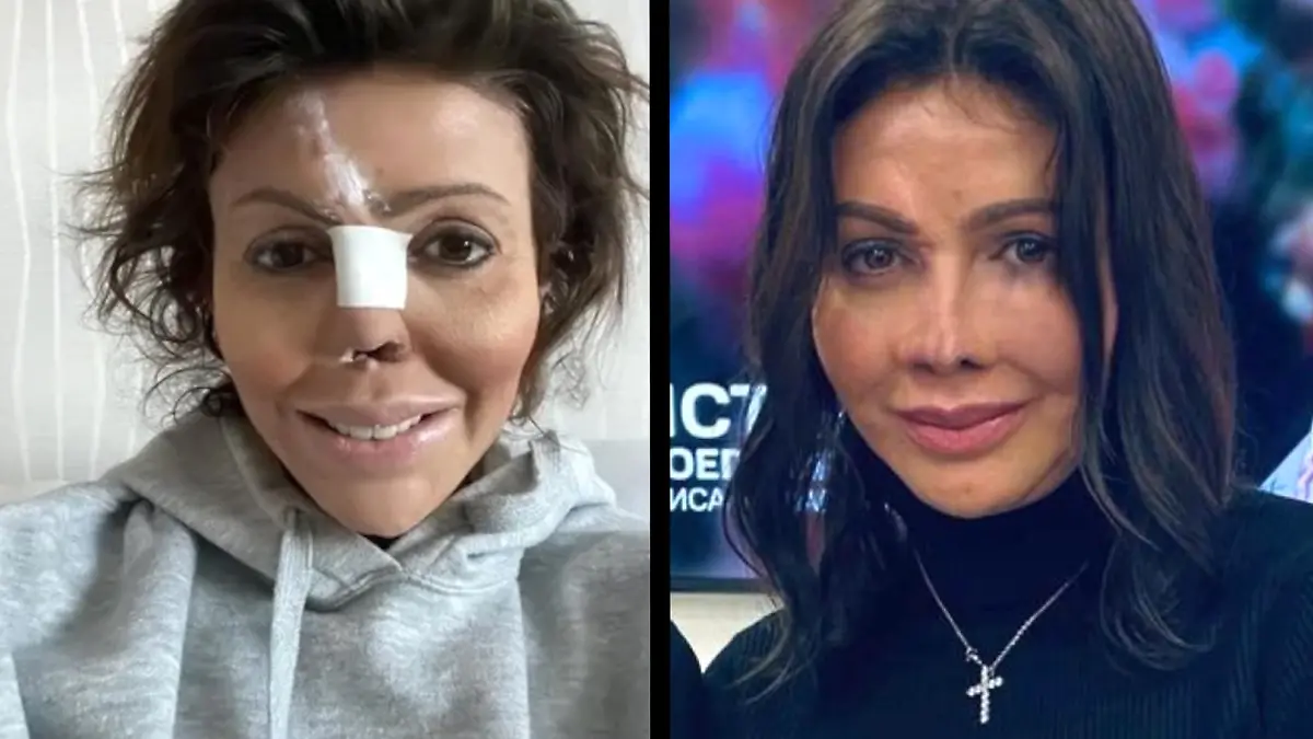 Alisa Kazmina (41) musste neun Operationen über sich ergehen lassen, damit ihre Nase nach einer verpfuschten Beauty-OP und Autoimmunerkrankung wieder einigermaßen normal aussieht.