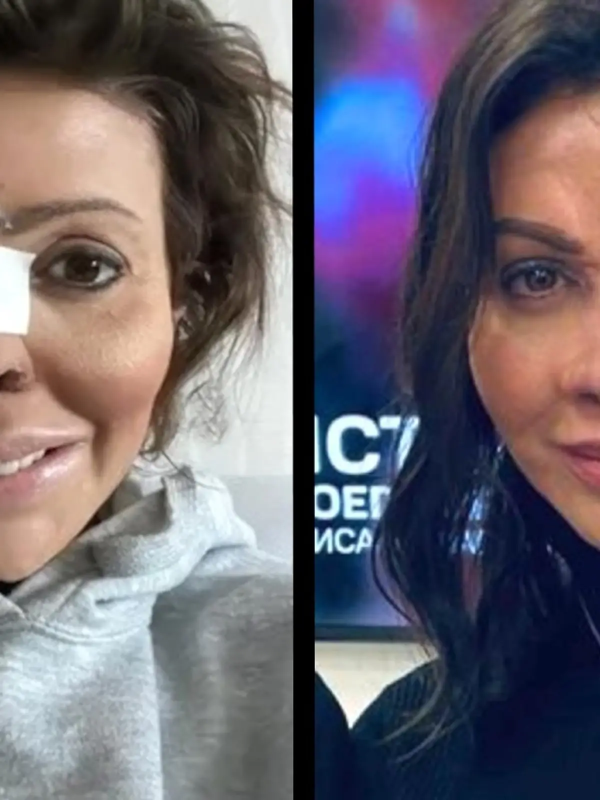 Alisa Kazmina (41) musste neun Operationen über sich ergehen lassen, damit ihre Nase nach einer verpfuschten Beauty-OP und Autoimmunerkrankung wieder einigermaßen normal aussieht.