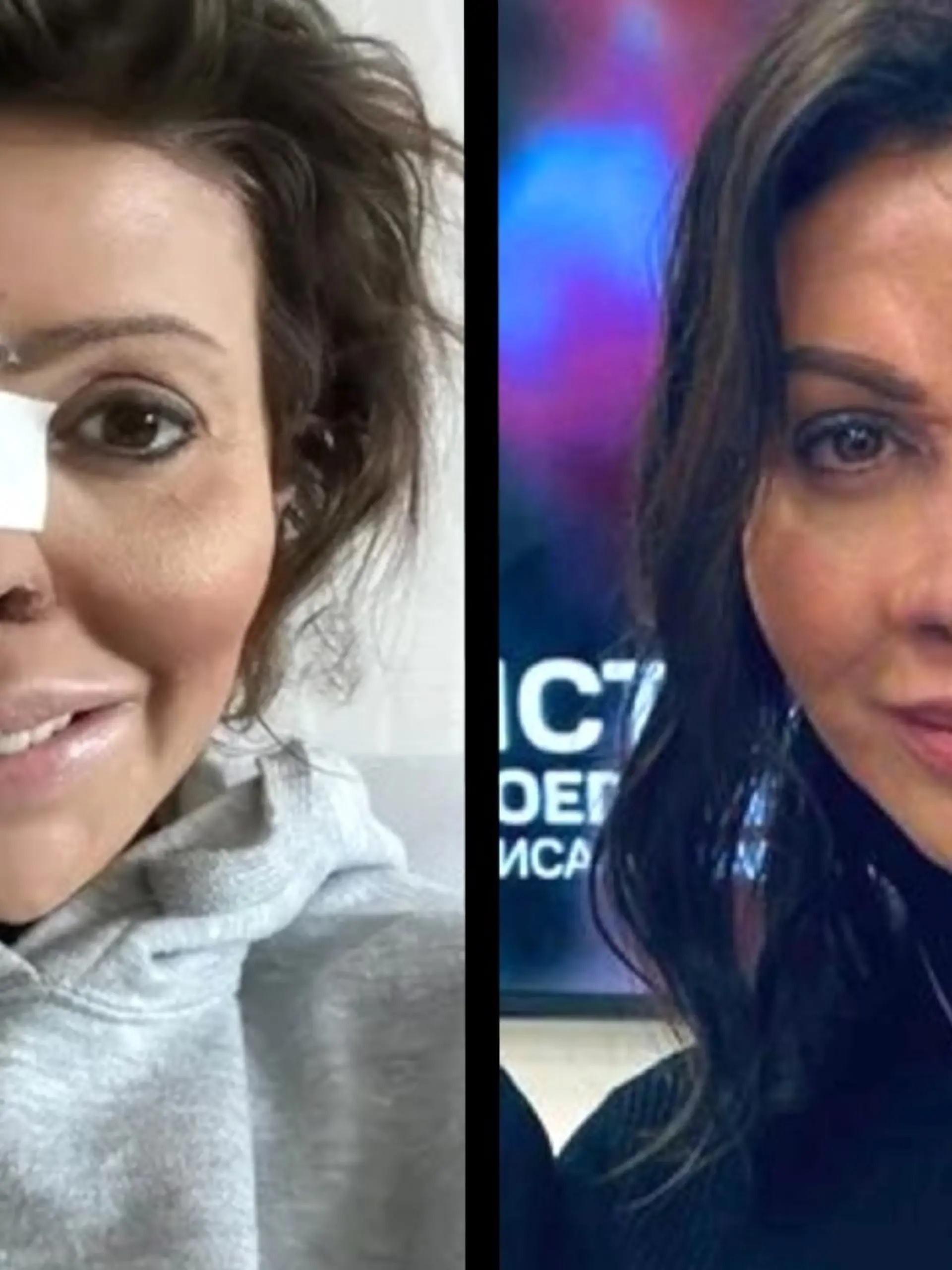 Alisa Kazmina (41) musste neun Operationen über sich ergehen lassen, damit ihre Nase nach einer verpfuschten Beauty-OP und Autoimmunerkrankung wieder einigermaßen normal aussieht.