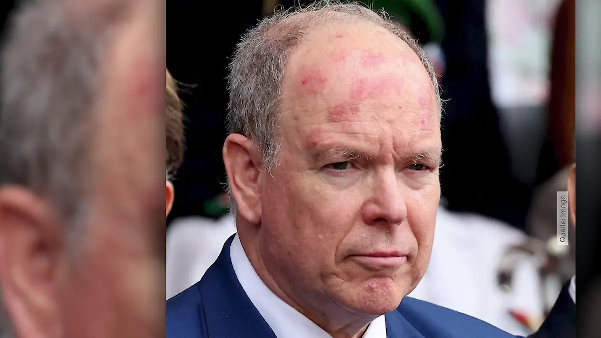 Was steckt hinter den roten Flecken auf Fürst Alberts Kopf? Sorge um Royal