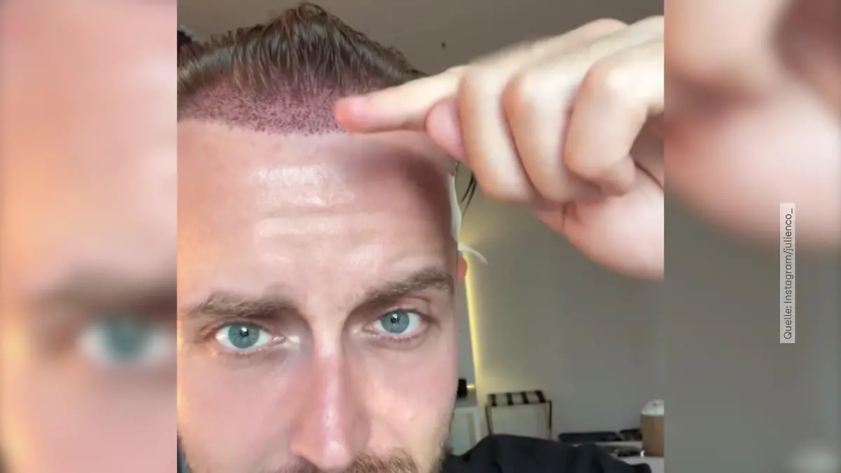 Julian Claßen zeigt das Ergebnis der Haartransplantation „So unglaublich glücklich“