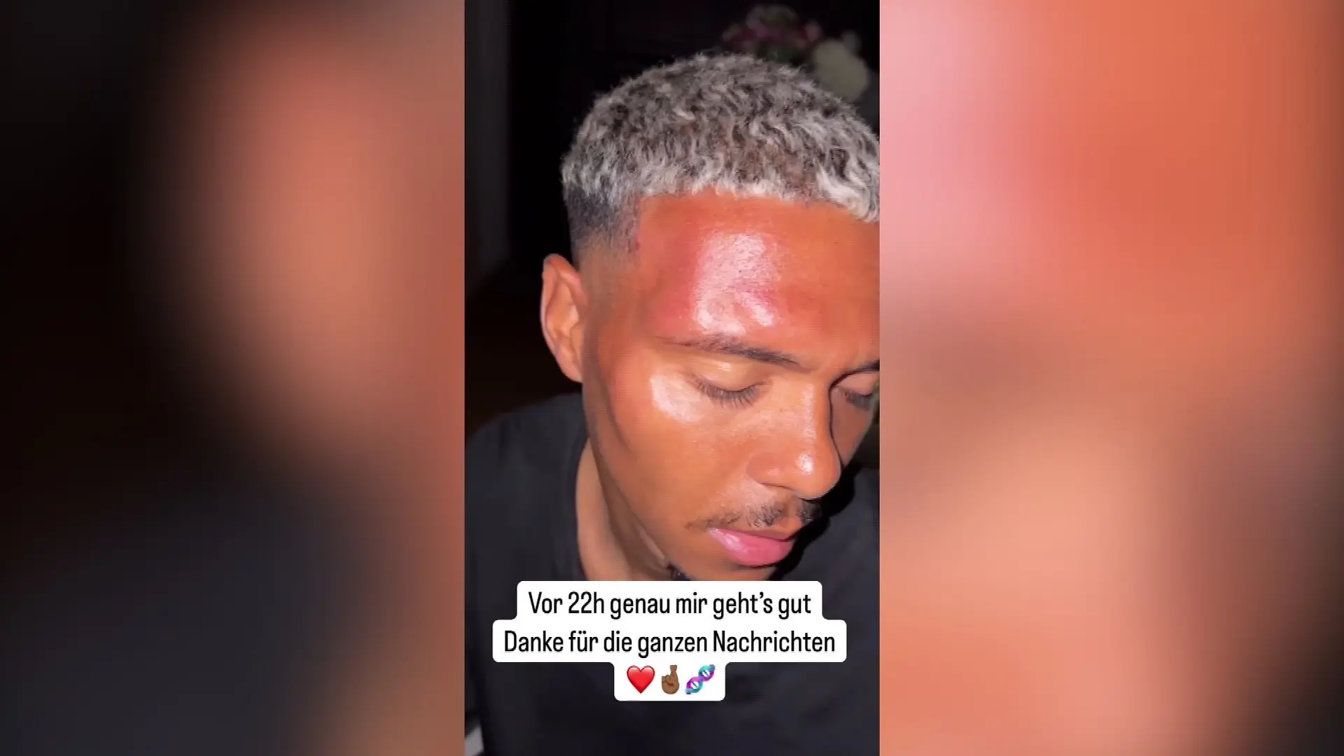 Die Stirn des Influencers ist rot und angeschwollen.