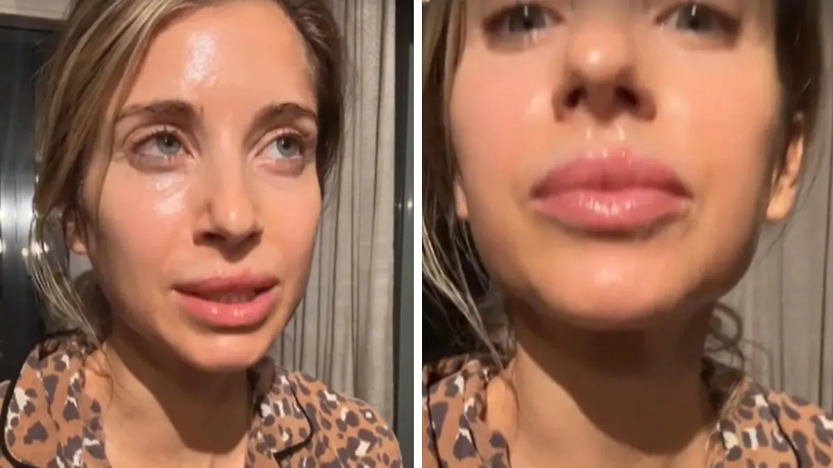 „Voller Topf Herpes!“ – Cathy Hummels leidet: Diese Lippe bringt sie zum Lachen