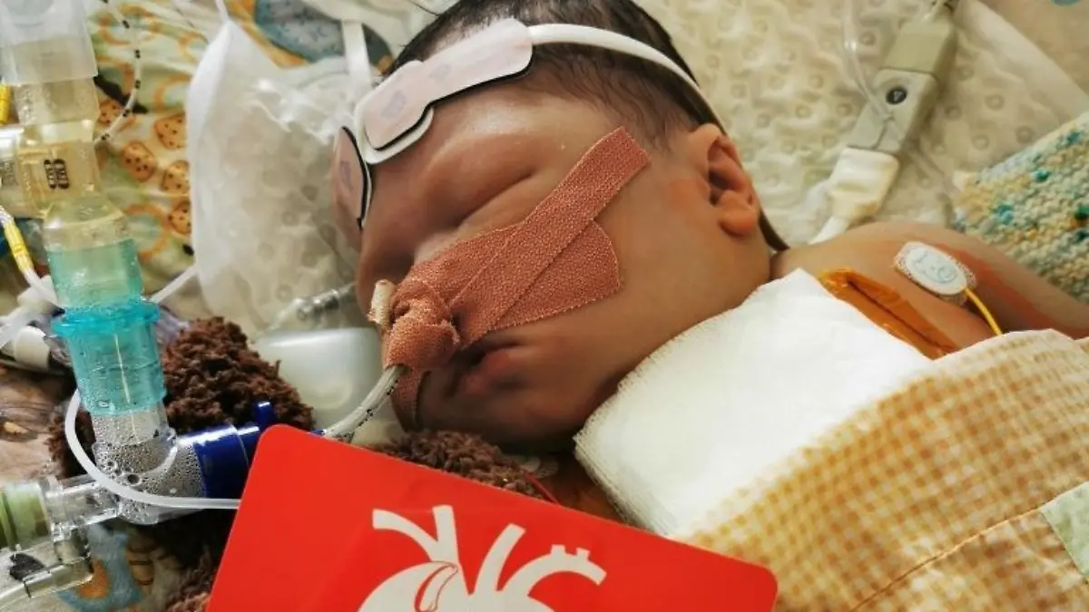Der kleine Alfie nach seiner ersten Operation, erst sechs Tage nach seiner Geburt. 