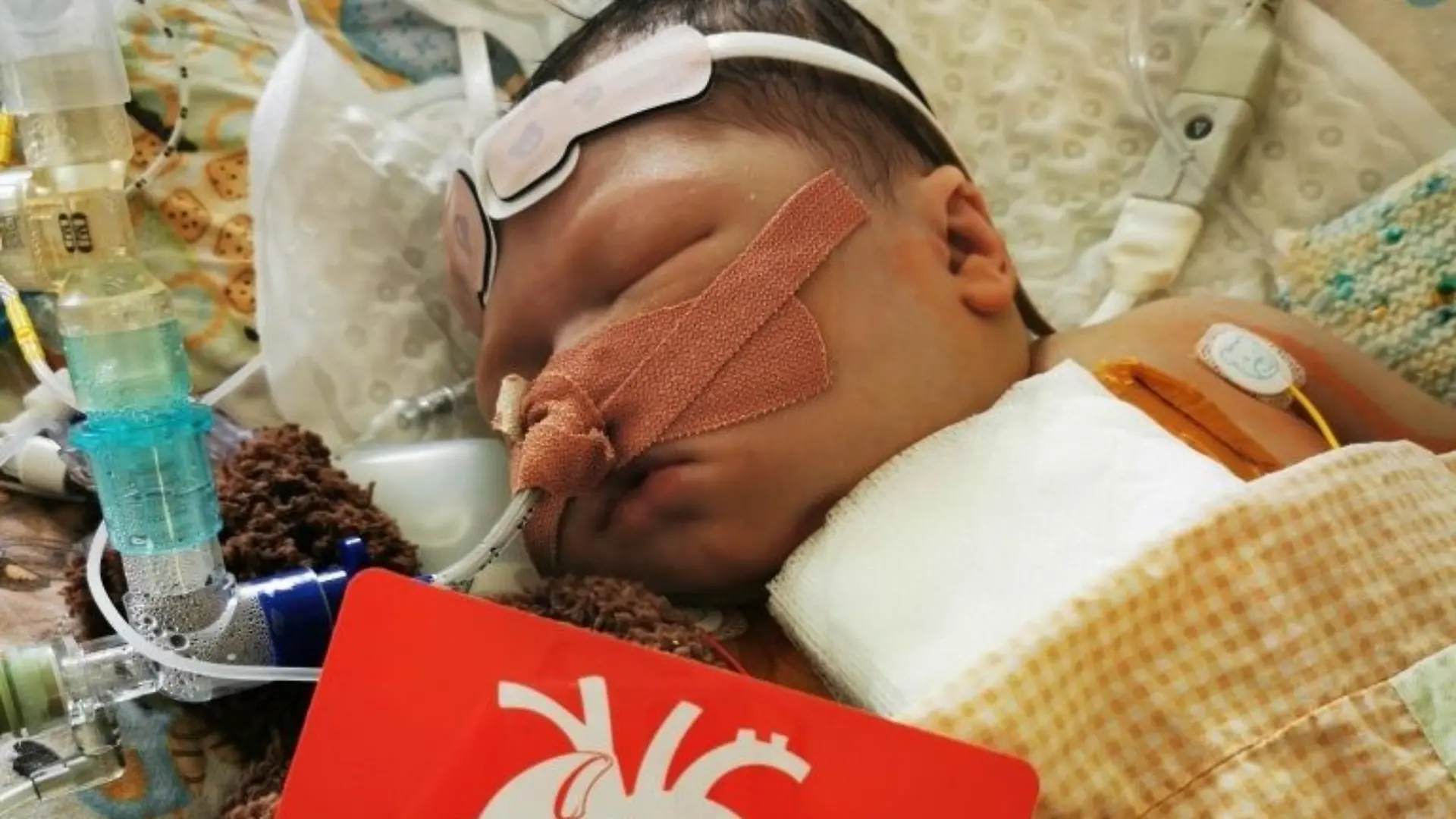 Der kleine Alfie nach seiner ersten Operation, erst sechs Tage nach seiner Geburt.
