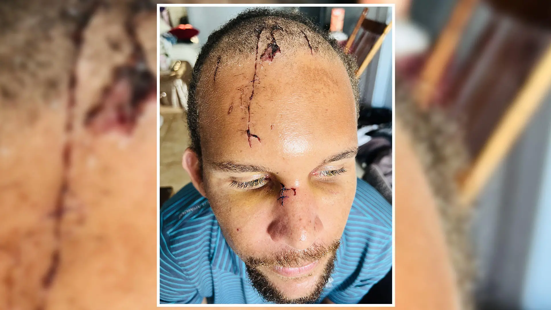 Joshua Young wurde in Belize von einem Krokodil attackiert - und überlebte.