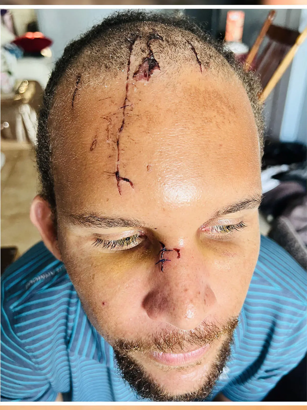 Joshua Young wurde in Belize von einem Krokodil attackiert - und überlebte.