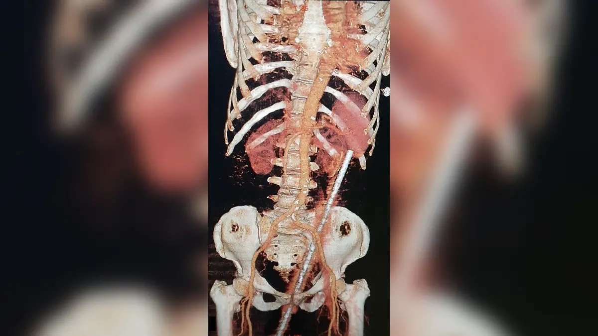Eine 60 cm lange Metallstange durchbohrte den Körper einer Inderin.