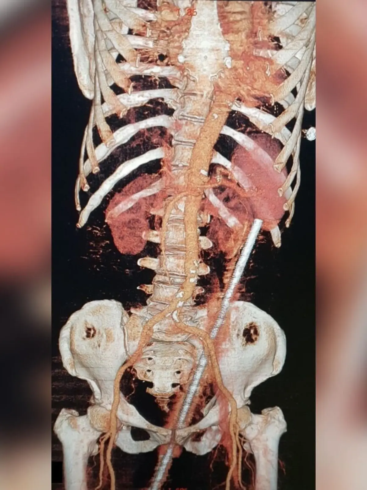 Bild zu: "Ärzte entfernen rostigen Metallstab aus Po einer Frau"