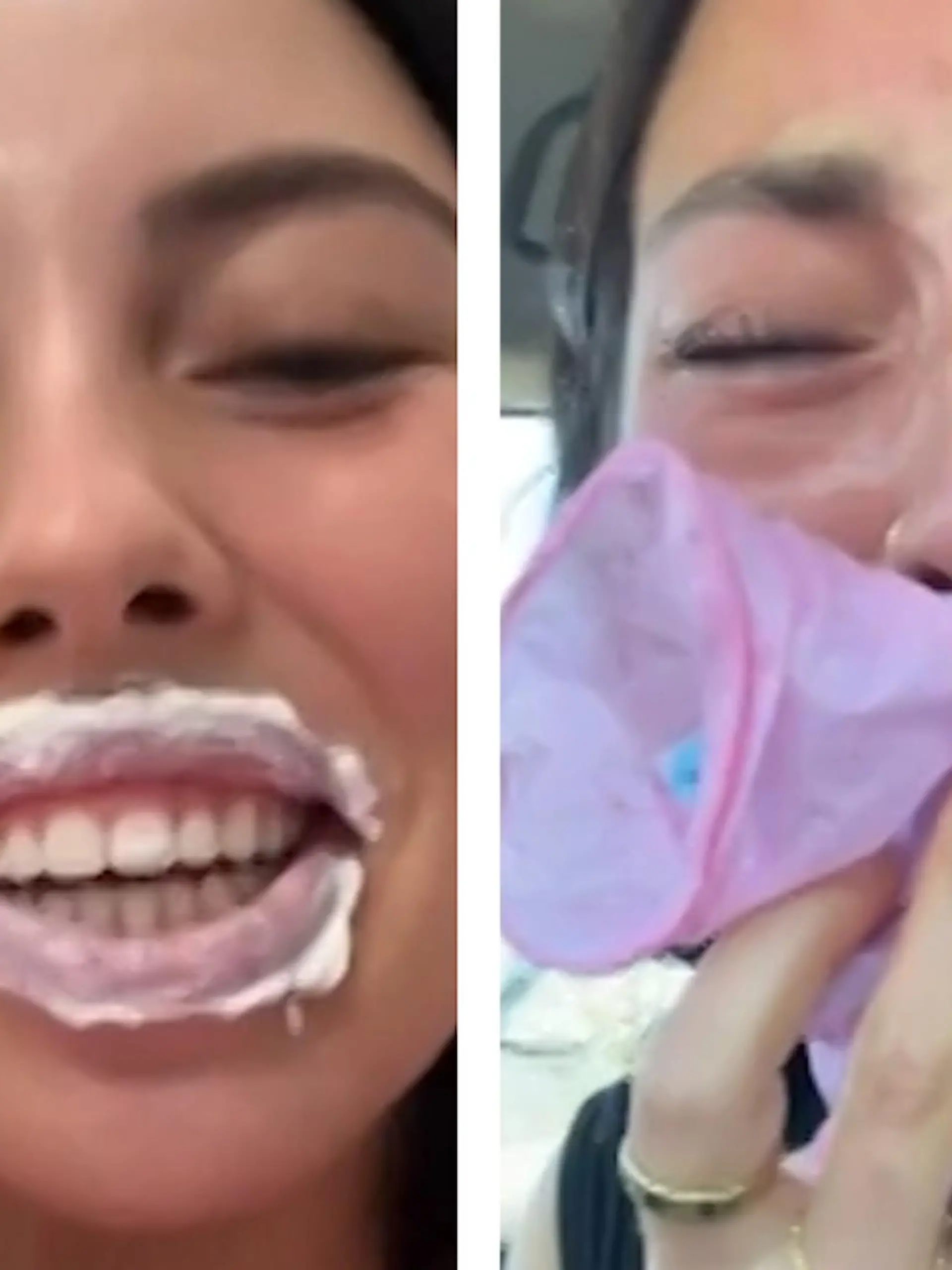 Bild zu: "SO sollte es nicht anschwellen! Frau hat Heulkrampf nach Beauty-Eingriff"