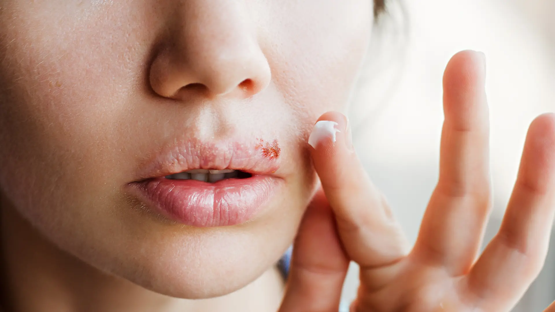 Kann man dem Ausbruch von Lippenherpes vorbeugen?