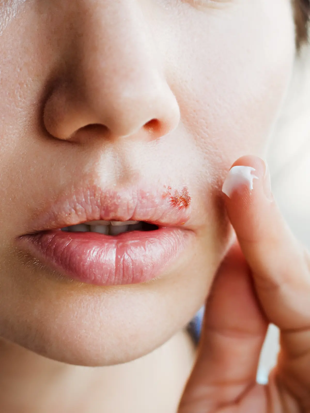 Kann man dem Ausbruch von Lippenherpes vorbeugen?
