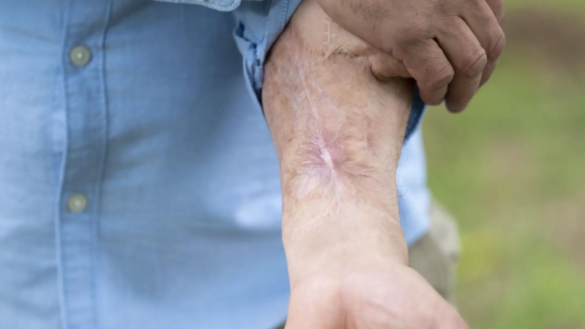 EXCLUSIVE! SONDERKONDITIONEN! DOPPELTER ANSTRICH! MINDESTHONORAR ? 200.- / Malcolm MacDonald,45, was devastated when his penis dropped off following a horror infection in 2014. A top doctor grafted a new one onto his arm until it was ready to attach.
Material must be credited "The Sun/News Licensing" unless otherwise agreed. 100% surcharge if not credited. Online rights need to be cleared separately. Strictly one time use only subject to agreement with News LicensingEXCLUSIVE! SONDERKONDITIONEN! DOPPELTER ANSTRICH! MINDESTHONORAR ? 200.- / Malcolm MacDonald,45, was devastated when his penis dropped off following a horror infection in 2014. A top doctor grafted a new one onto his arm until it was ready to attach. (VIDEO vorhanden)
Material must be credited "The Sun/News Licensing" unless otherwise agreed. 100% surcharge if not credited. Online rights need to be cleared separately. Strictly one time use only subject to agreement with News Licensing