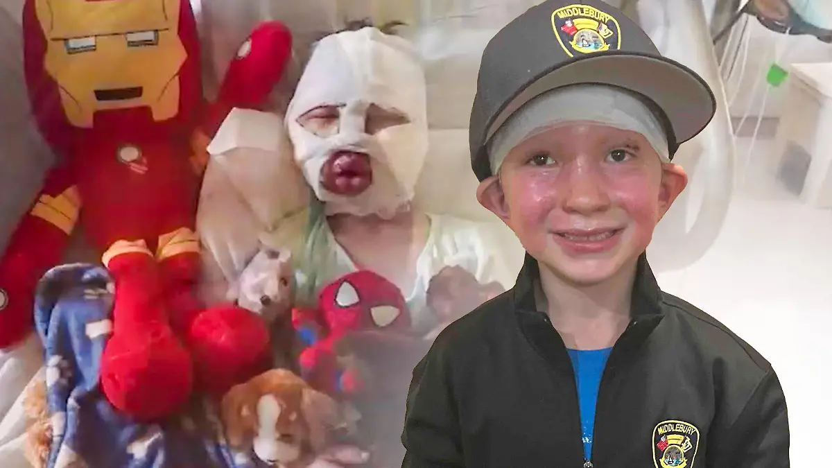 Der kleine Dominick kann nach der schrecklichen Feuerball-Attacke wieder lachen