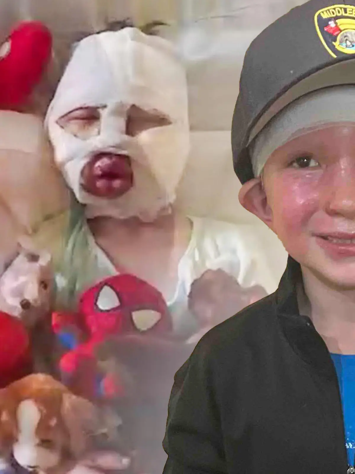 Der kleine Dominick kann nach der schrecklichen Feuerball-Attacke wieder lachen