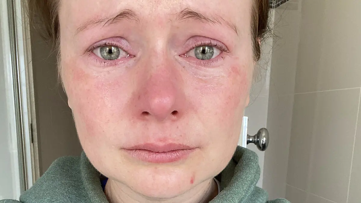 Erin Orchard nach der Augenlaseroperation