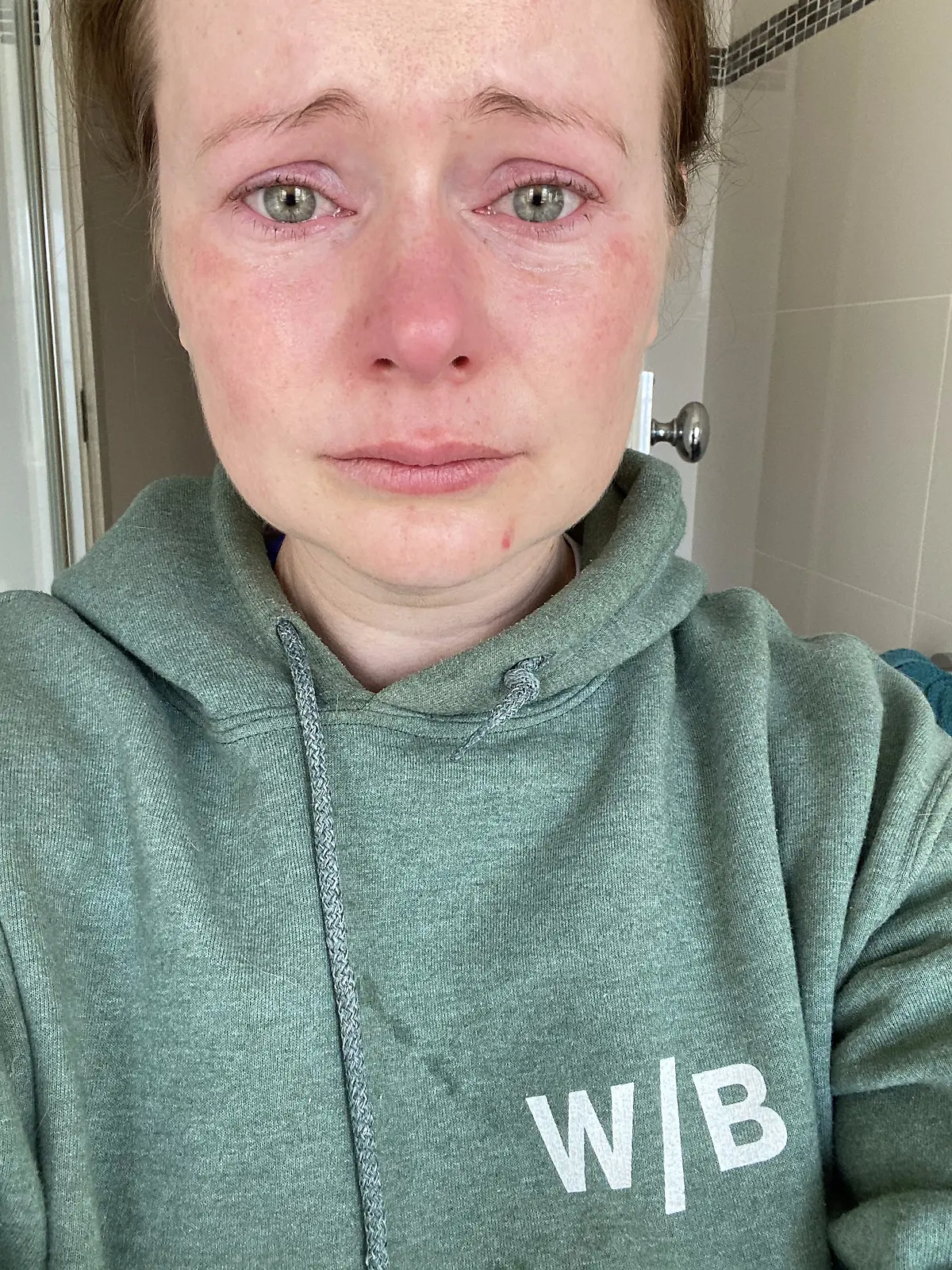 Erin Orchard nach der Augenlaseroperation