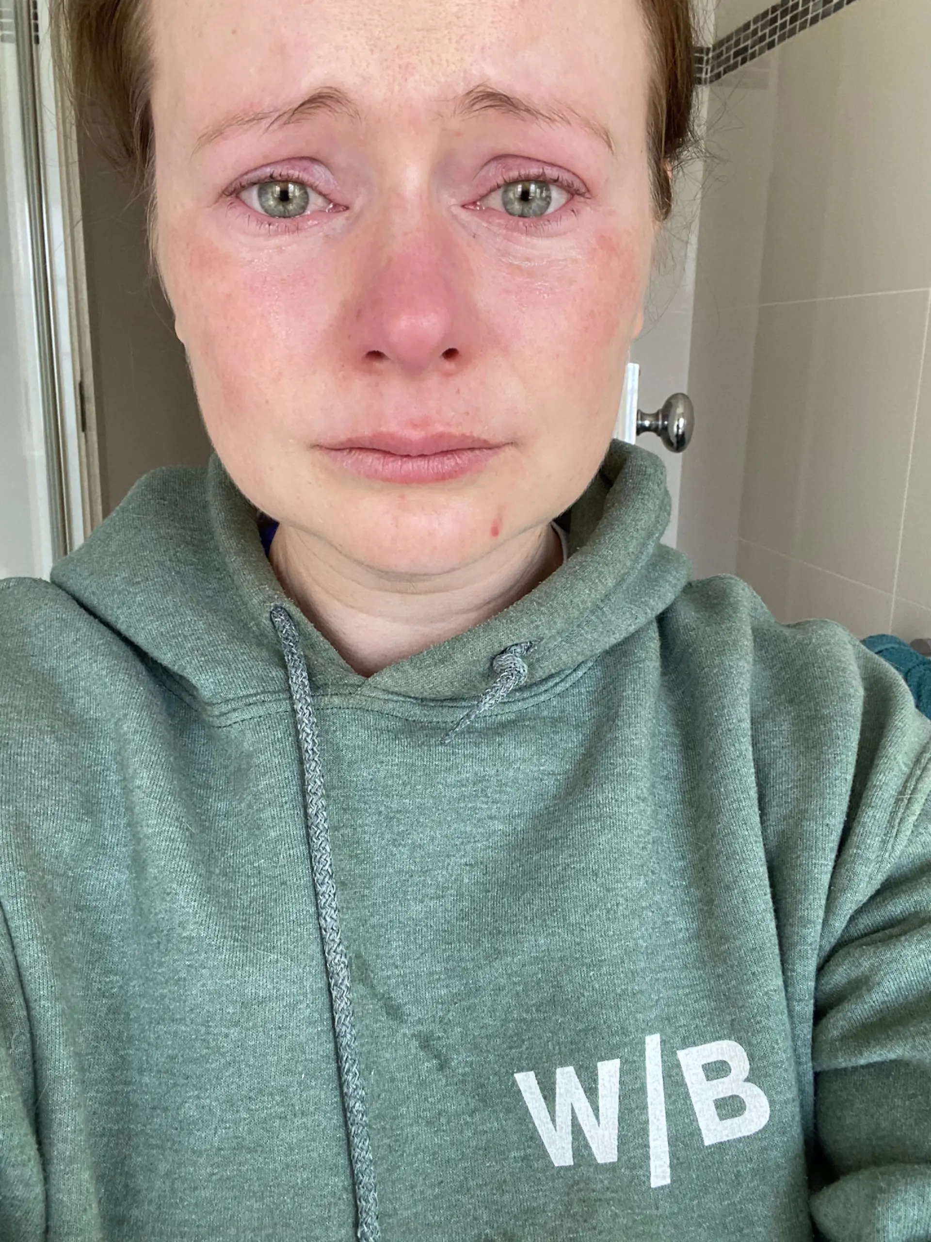 Erin Orchard nach der Augenlaseroperation