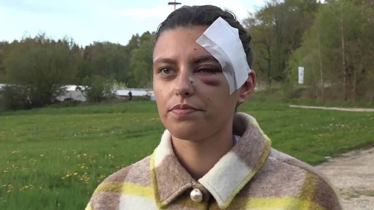 Vanessa Hampl hat große Sorgen, dass der Angriff Narben hinterlassen wird.