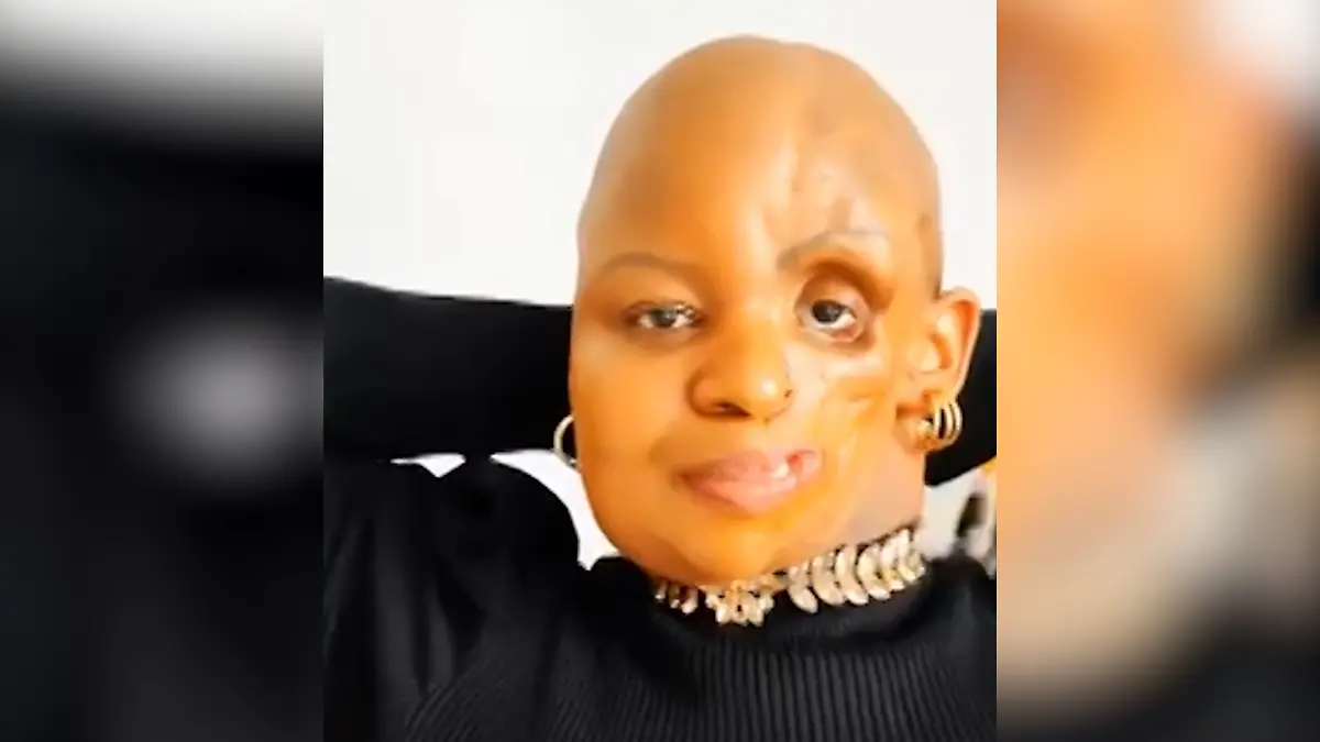 Frau verliert halbes Gesicht, aber nie ihr Lächeln