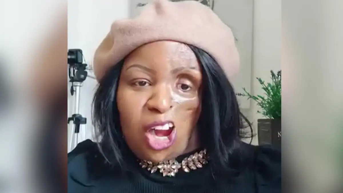 Frau verliert das half Gesicht - aber nie ihr Lächeln Jahrelang hofft sie een Diagnose