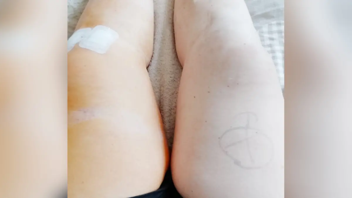 Die Textmarker-Markierung auf dem rechten Knie war vor der OP noch sichtbar.