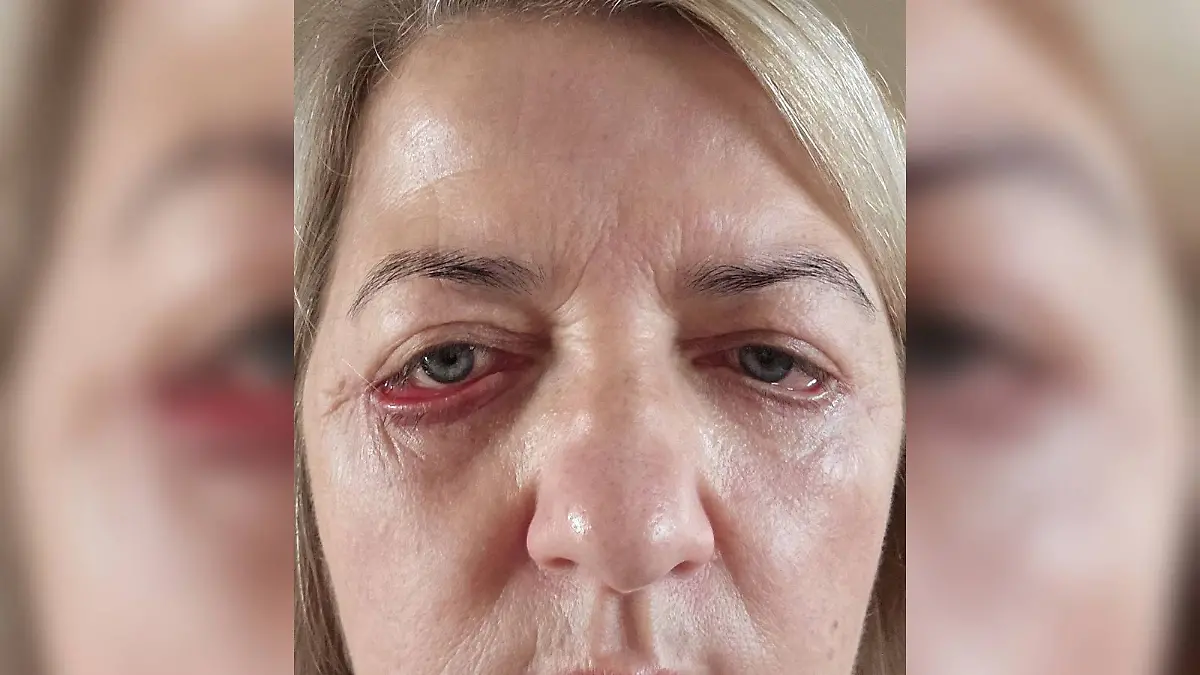 Lidstraffung in der Türkei ging schief