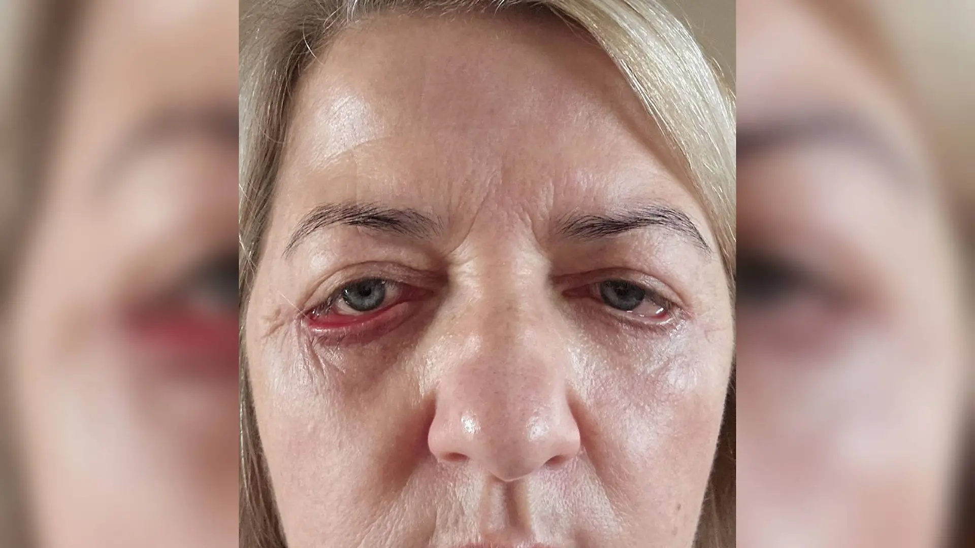Lidstraffung in der Türkei ging schief