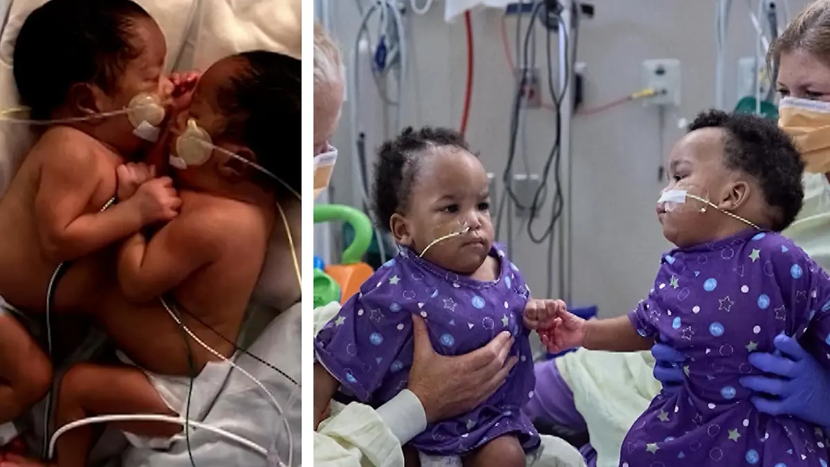 Wie Viele Siamesische Zwillinge Gibt Es In Deutschland www.rtl.de