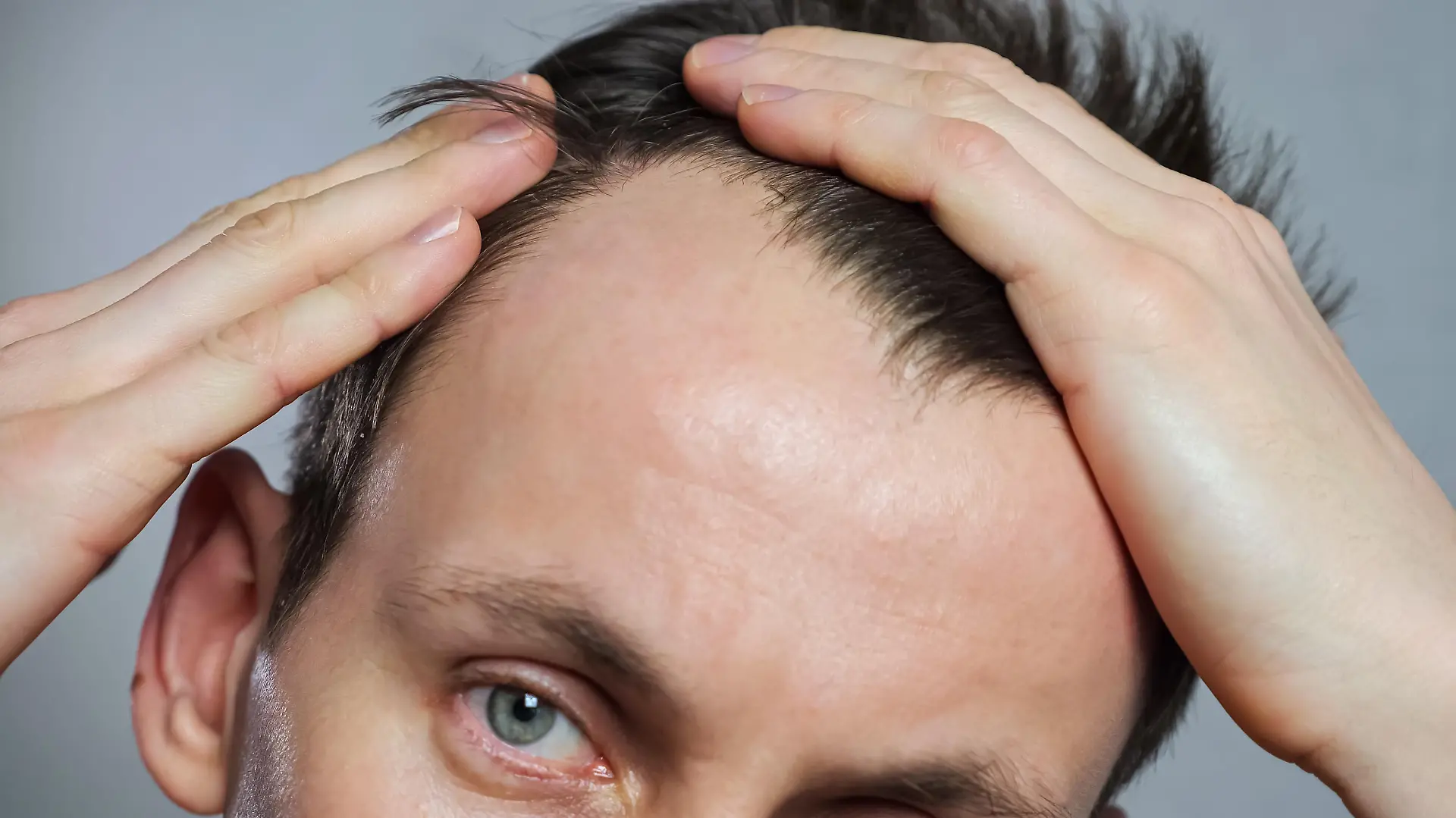 Young man with bald spots suffering from hair loss, closeup
