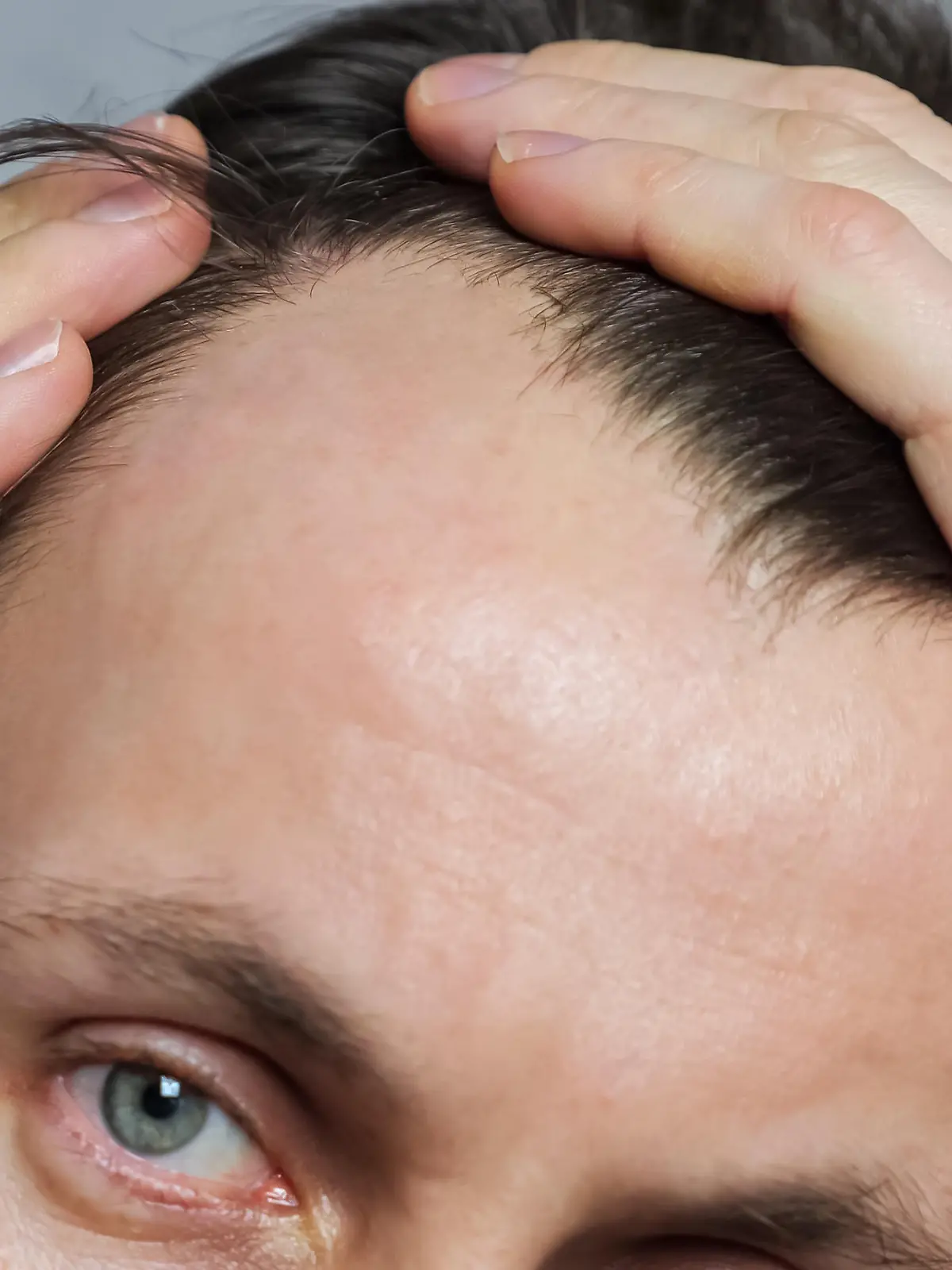 Young man with bald spots suffering from hair loss, closeup