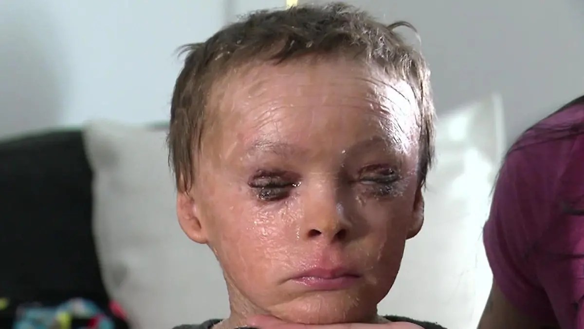 Junge (7) kann Augen nicht schließen – hilft OP? Wegen Hautkrankheit!