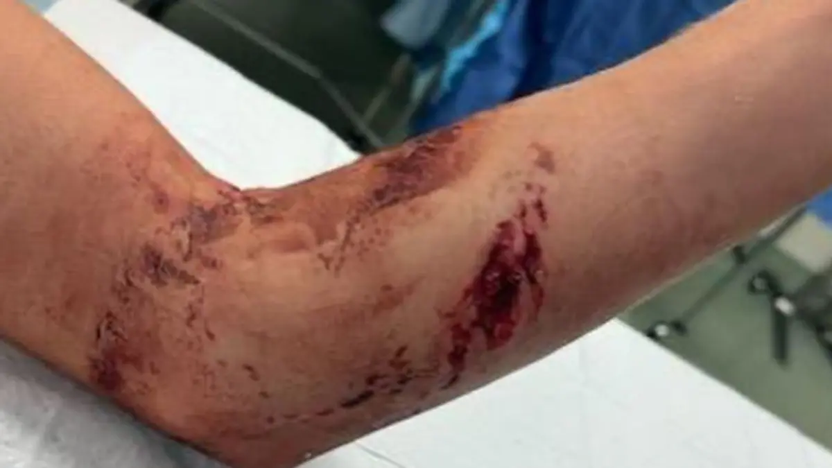 Der Hai beißt ein Stück Fleisch aus Teddys Arm heraus (re.)