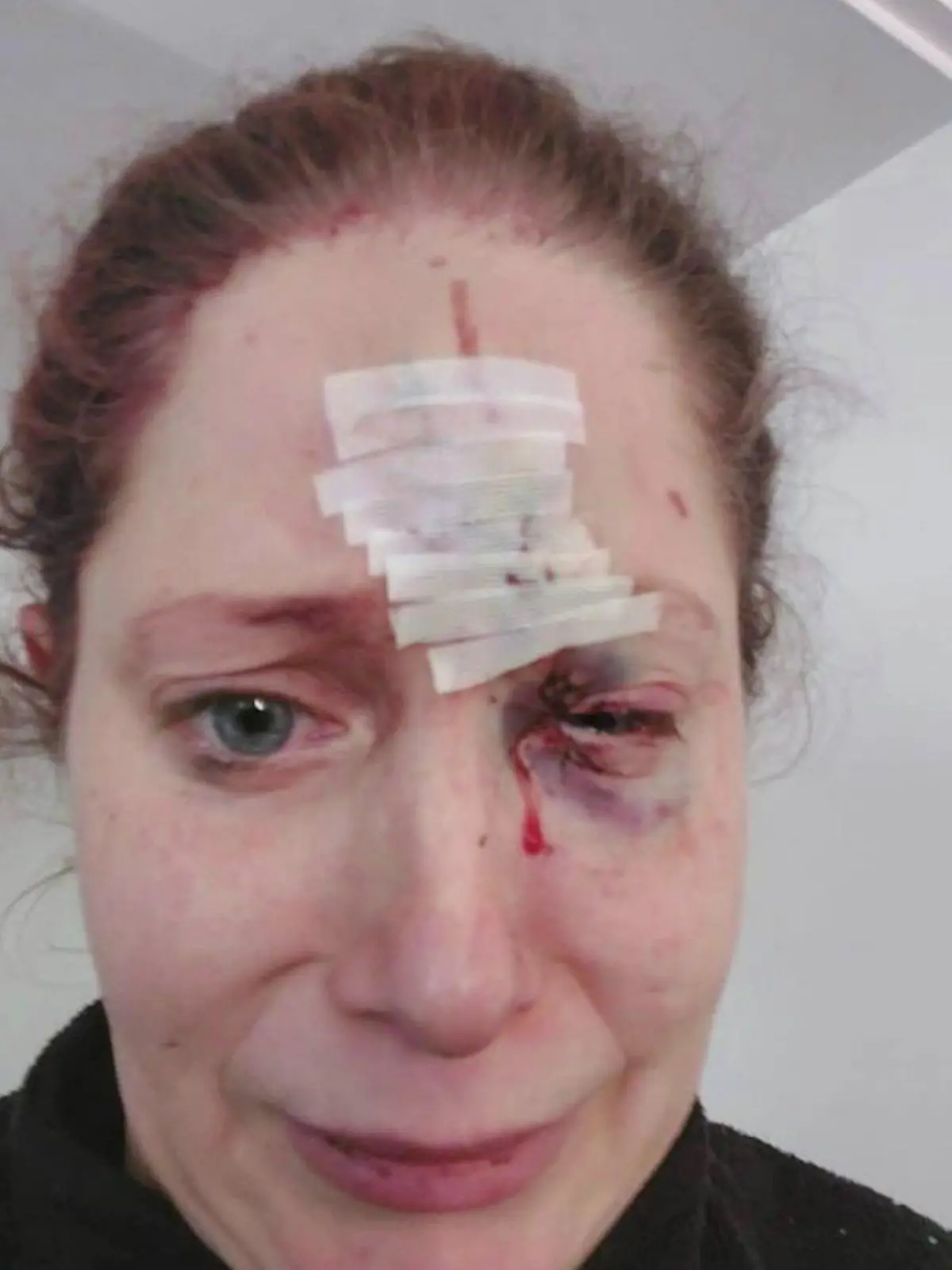 Nicole Kilians linke Gesichtshälfte ist nach einem Hundeangriff schwer verletzt.
