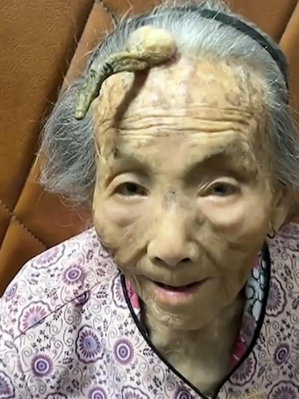 Bild zu: "Frau (107) wächst ein Horn aus dem Kopf – warum das jedem passieren kann"