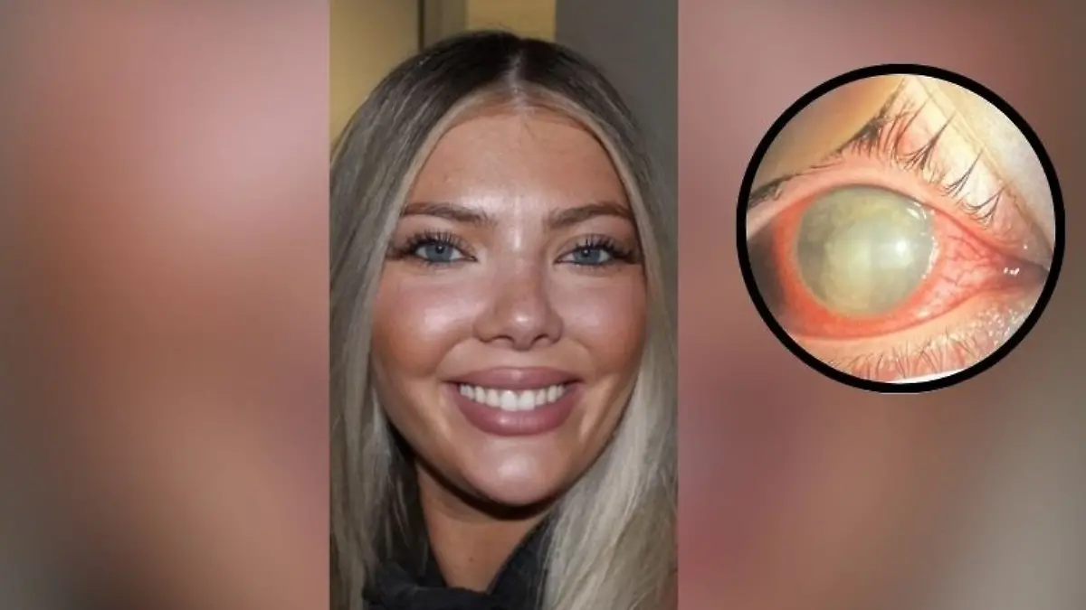 Barista Brooklyn McCasland und ihr Auge, nachdem sie wegen einer Infektion erblindet ist.