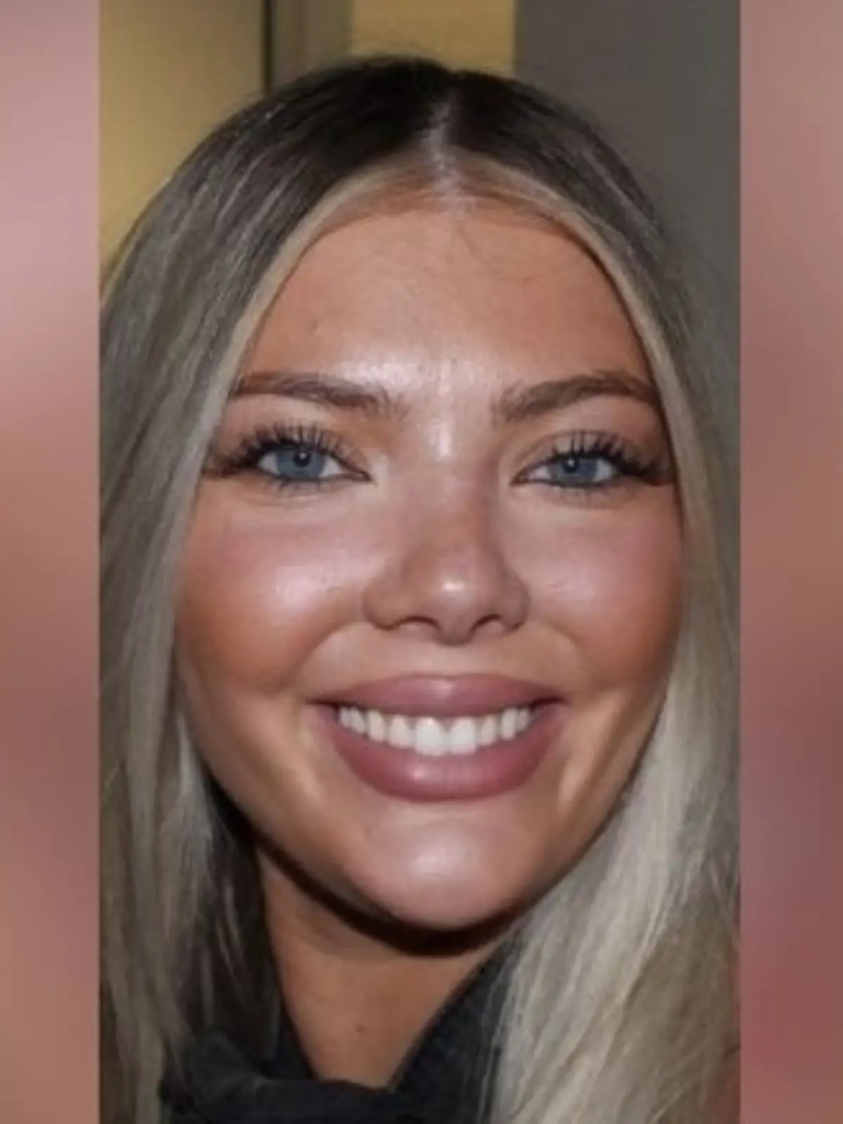 Barista Brooklyn McCasland und ihr Auge, nachdem sie wegen einer Infektion erblindet ist. 
