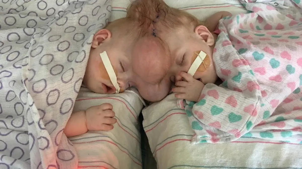 SONDERKONDITIONEN: Satzpreis!
Erin (left) and Abby (right) shortly after they were born. See SWNS story SWFTconjoined. Rare conjoined twins who survived separation surgery despite just 2% chance of survival have graduated kindergarten. Mum Heather Delaney, 33, learned at just 11 weeks pregnant that she was carrying conjoined twin baby girls. Connected at the head - known as craniopagus twins - the babies had a low chance of survival, but fought against the odds. / action press
