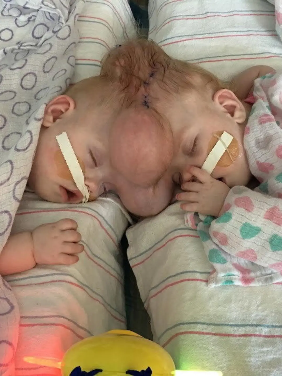 SONDERKONDITIONEN: Satzpreis!
Erin (left) and Abby (right) shortly after they were born. See SWNS story SWFTconjoined. Rare conjoined twins who survived separation surgery despite just 2% chance of survival have graduated kindergarten. Mum Heather Delaney, 33, learned at just 11 weeks pregnant that she was carrying conjoined twin baby girls. Connected at the head - known as craniopagus twins - the babies had a low chance of survival, but fought against the odds. / action press
