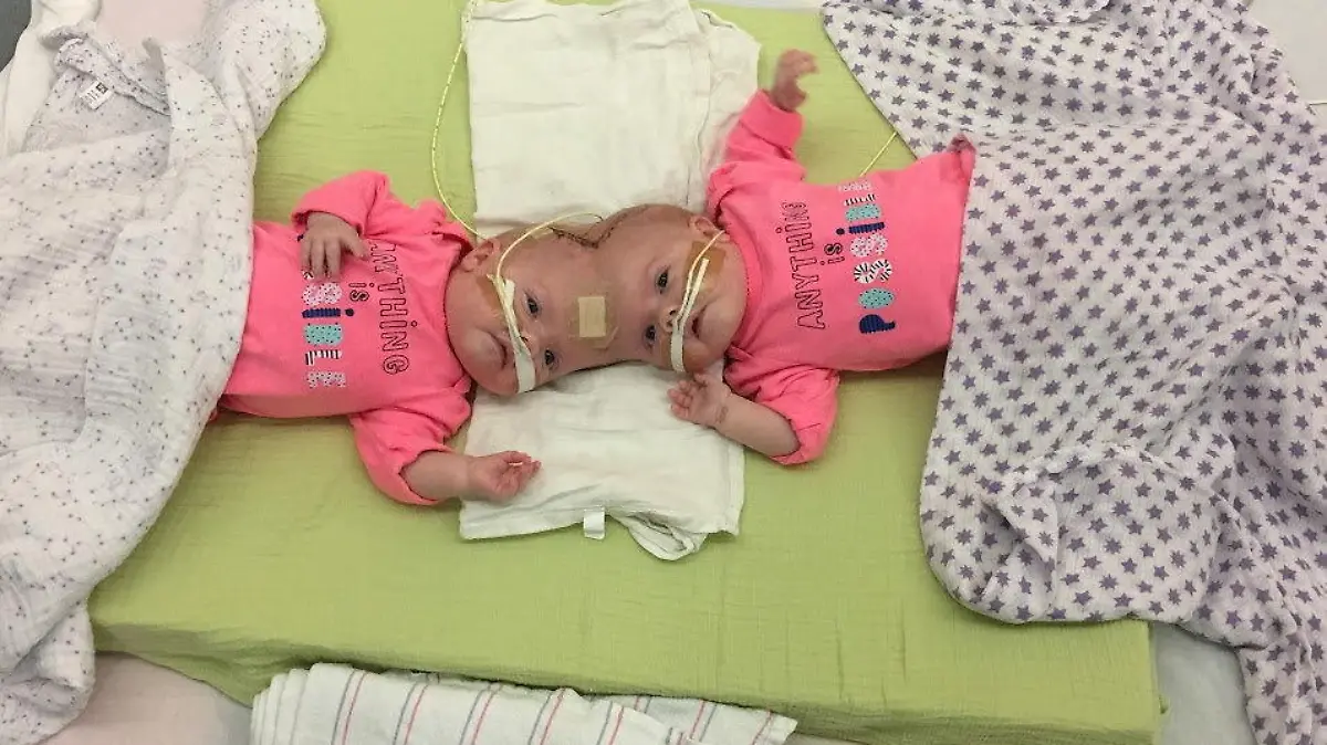 SONDERKONDITIONEN: Satzpreis!
Twins Abby and Erin were born conjoined. See SWNS story SWFTconjoined. Rare conjoined twins who survived separation surgery despite just 2% chance of survival have graduated kindergarten. Mum Heather Delaney, 33, learned at just 11 weeks pregnant that she was carrying conjoined twin baby girls. Connected at the head - known as craniopagus twins - the babies had a low chance of survival, but fought against the odds. / action press
