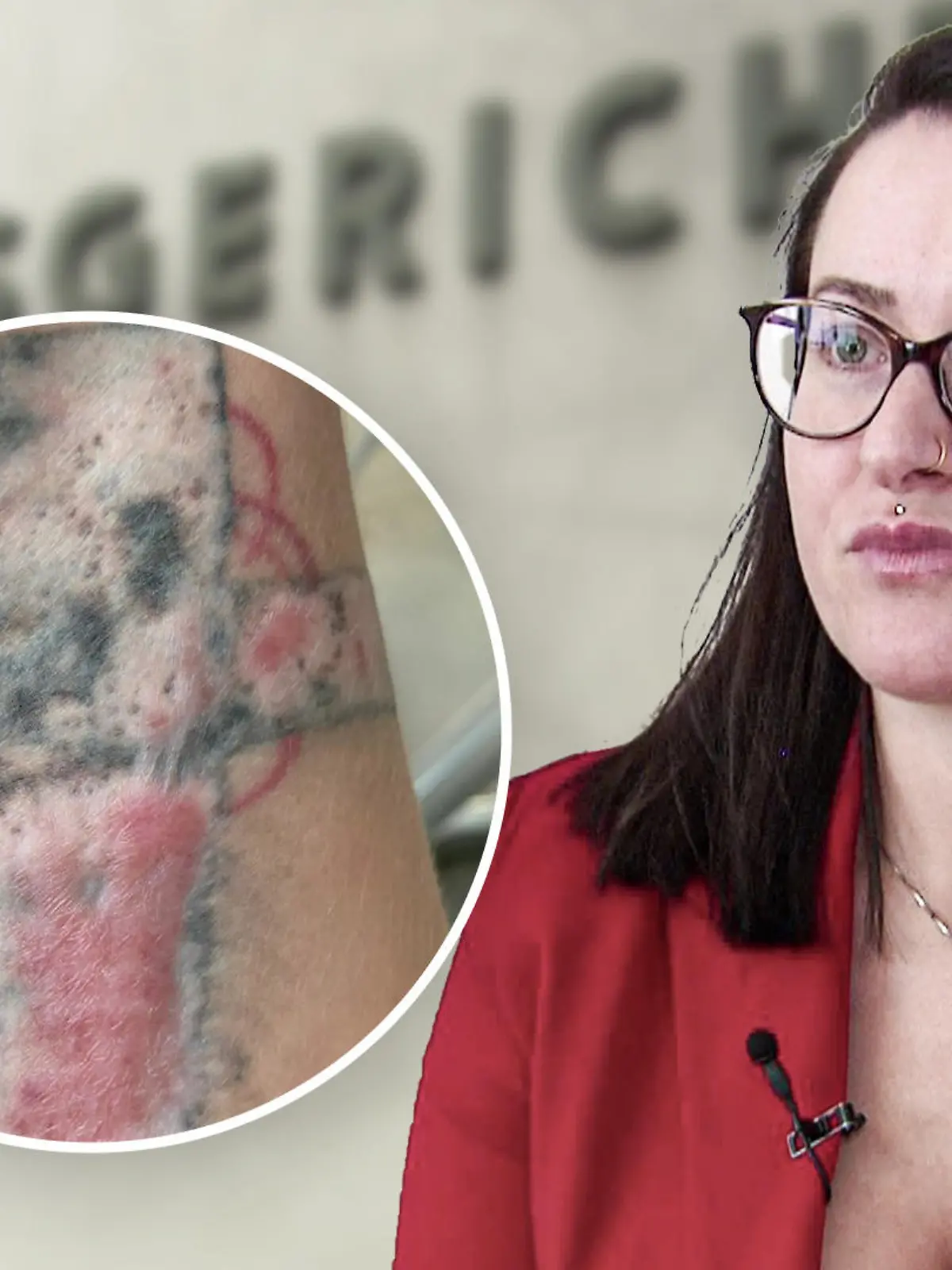 TEASER_Pfusch bei Tattoo-Entfernung- Jacquelins Unterarm wurde verbrannt.jpg
