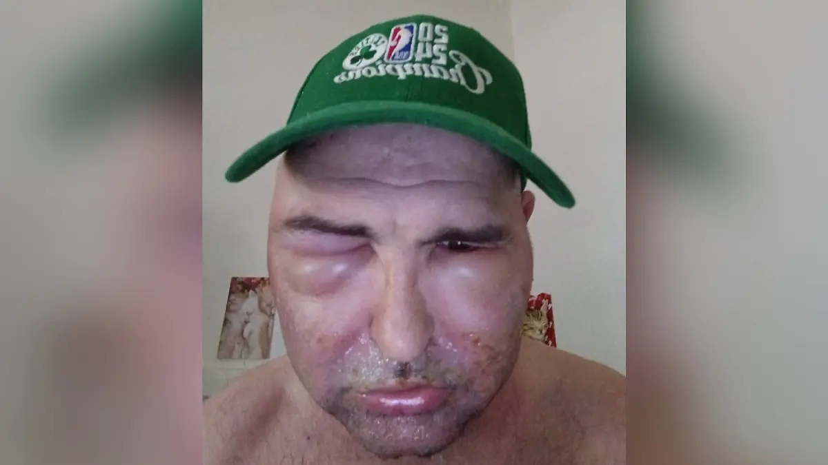 Scott (50) erleidet allergische Reaktion, nachdem er seinen Bart färben wollte.