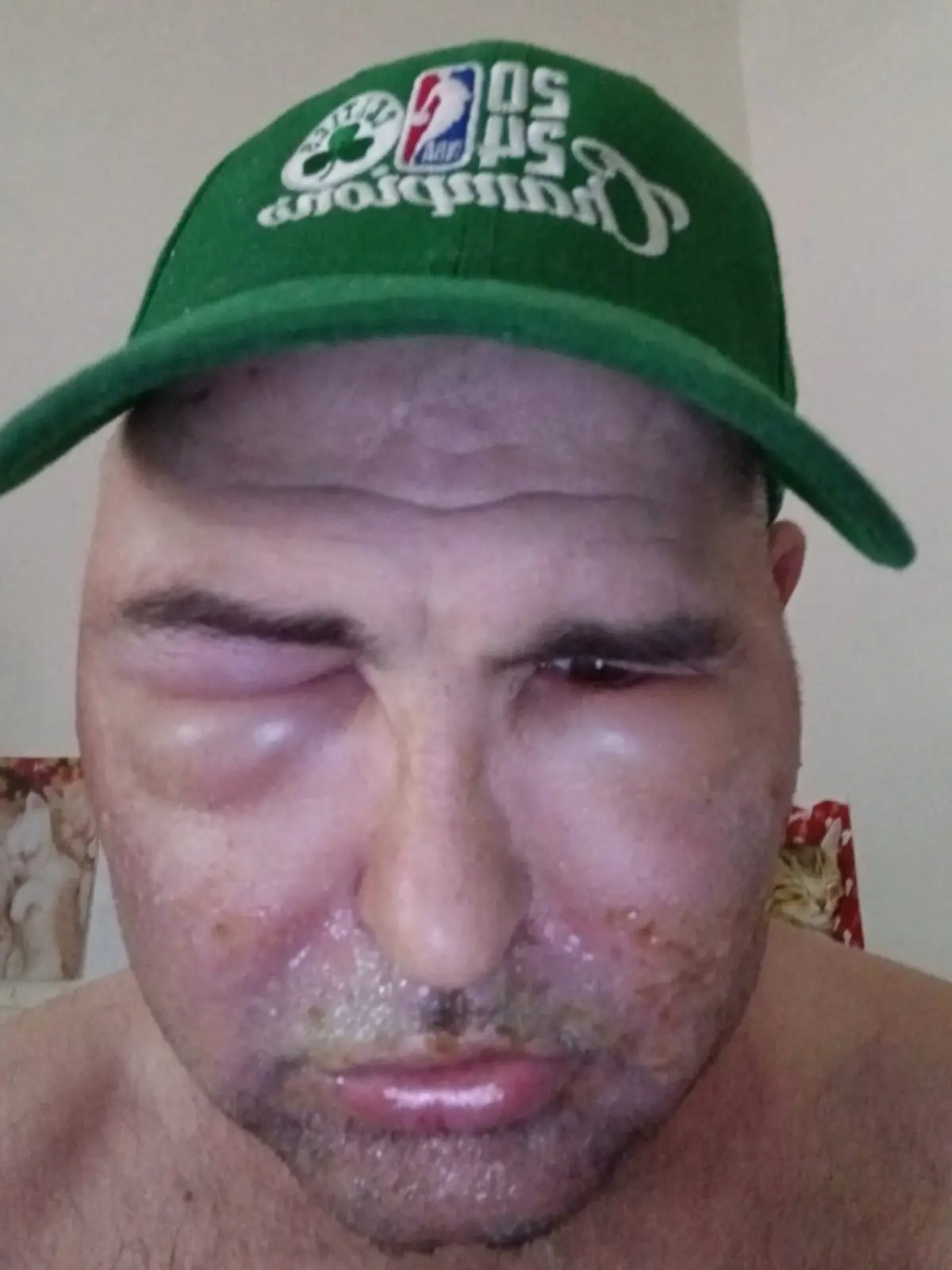 Scott (50) erleidet allergische Reaktion, nachdem er seinen Bart färben wollte. 