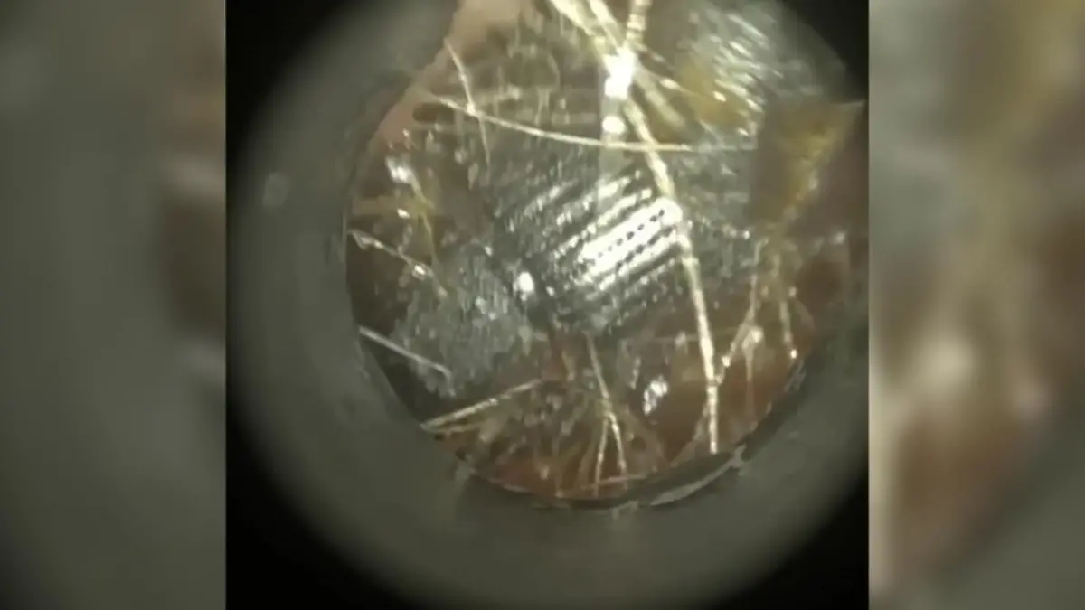 Blockade im Gehörgang! Arzt macht Ekel-Fund