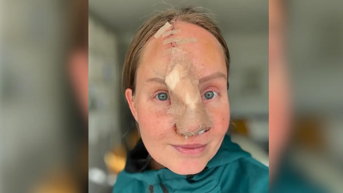 Kurz nach ihrer Op im November ist für Charlotta langsam das Ende in Sicht. Für sie stehen nun nur noch zwei letzte Eingriffe an, dann ist ihre neue Nase fertig.