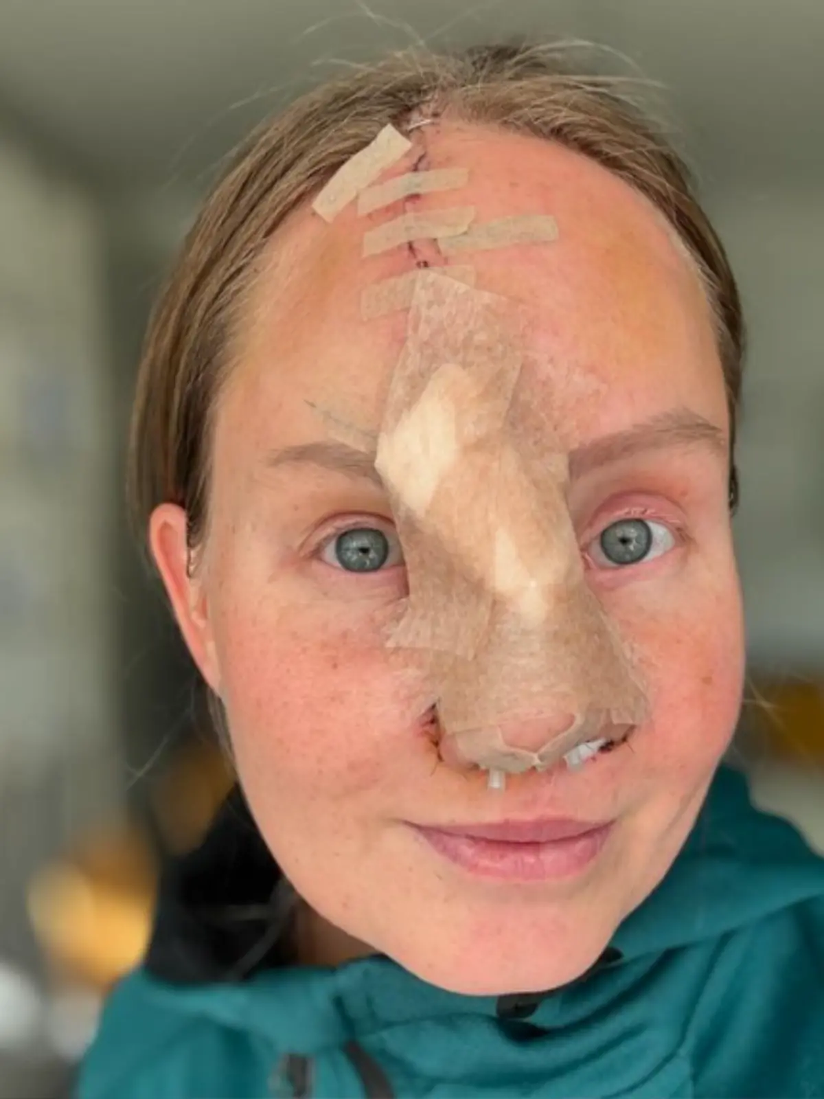 Kurz nach ihrer Op im November ist für Charlotta langsam das Ende in Sicht. Für sie stehen nun nur noch zwei letzte Eingriffe an, dann ist ihre neue Nase fertig. 