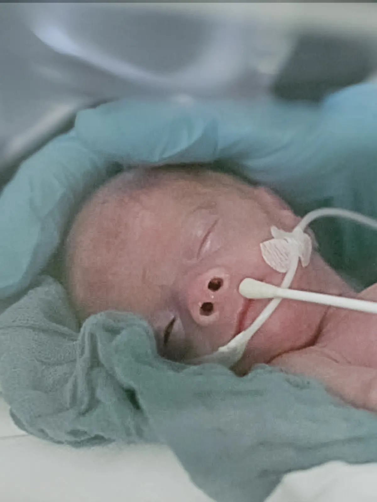 In der 25 Schwangerschaftswoche kommt die kleine Tochter von Samantha mit nur 490 Gramm zur Welt. 