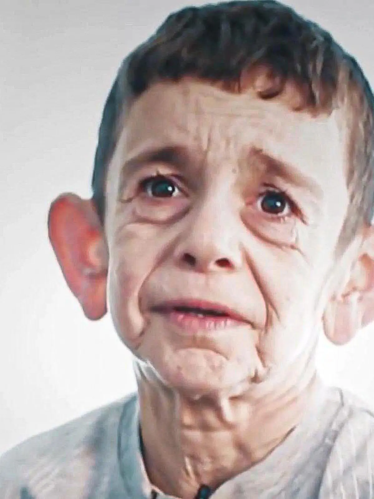 Mohamed hat eine genetische Krankheit namens Cutis Laxa